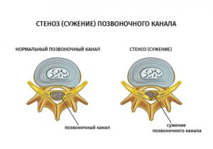 Ортез позвоночника ОТ-10 ЧЕРНЫЙ